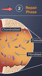 117K views · 714 reactions | After spinal fusion surgery, the bone healing process follows three stages. | Spine-health | Facebook