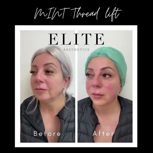 PDO thread lift before and after