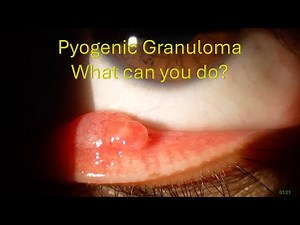 0121: Pyogenic Granuloma - What can you do?