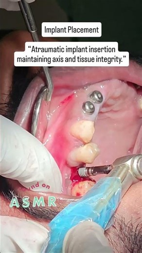 See How a Dental Implant Is Done Without Cutting | Flapless Keyhole Implant Placement – Full Process