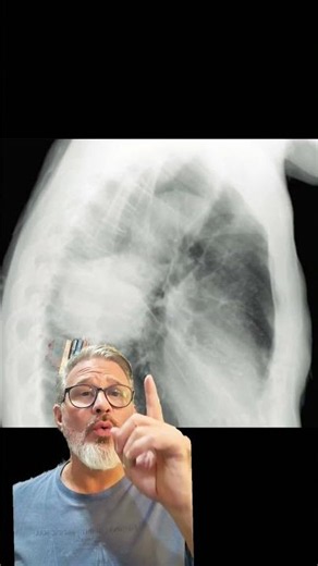 👨‍⚕️ Silhouette Sign + Lateral View: Never Get Your Chest X-Rays Wrong Again!