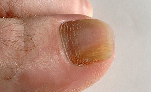 How To Prevent Nail Fungus (And Treat It If It's Already Present)