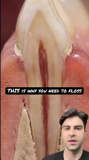 Why Your Dentist Obsesses Over Flossing Ever wonder why your dentist is obsessed with flossing? This shocking dental animation shows exactly what happens when you skip it.Watch a healthy tooth rapidly progress from perfect gums to swollen gingivitis, deep periodontal pockets, severe bone loss, and the pulp inside turning necrotic.This is the real progression of untreated plaque buildup leading to gum disease (periodontitis). Brushing alone isn’t enough — flossing removes the plaque and bacteria