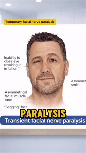 Dentistry on Instagram: "Patient can’t smile or blink after an inferior alveolar nerve block. 😳 This is transient facial nerve paralysis — not nerve damage. It occurs when the anesthetic is deposited too posteriorly, inside the parotid gland, affecting the facial nerve instead of the inferior alveolar nerve. 🦷 Key points: • Sudden inability to blink • Asymmetrical smile • Temporary condition • Full recovery expected in a few hours 🎯 Management: Reassure the patient. Protect the eye. No treatm
