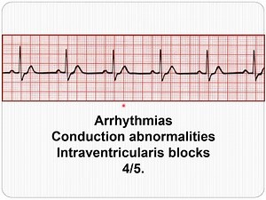 ECG Arrhythmias - Intraventricular conduction abnormalities 4/5