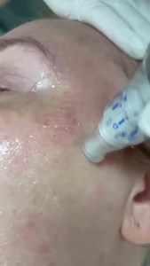 Microneedling In Action
