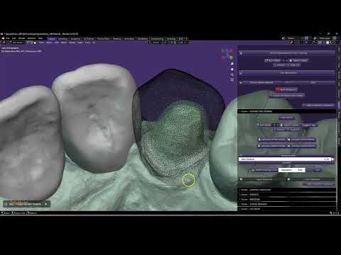 Making crowns and implant crowns... Easy! Follow this video.