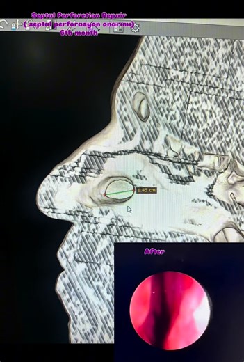 Doç. Dr. Bilal Sizer on Instagram: "Septal perforation repair!!! It has been six months since the septal perforation repair surgery. We are very happy that everything is going well. #septalperforasyononarımı #septalperforation #septalperforation #septumperforasyonu #septumperforation #septumperforasyonuameliyatı #bilalsizerklinik Our clinic is officially authorized by the Turkish Ministry of Health with an International Health Tourism Certificate. All patient photos and videos shared on this pag