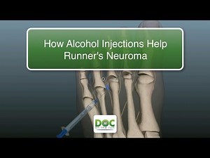 How Alcohol Injections Help Runners with Neuroma Pain