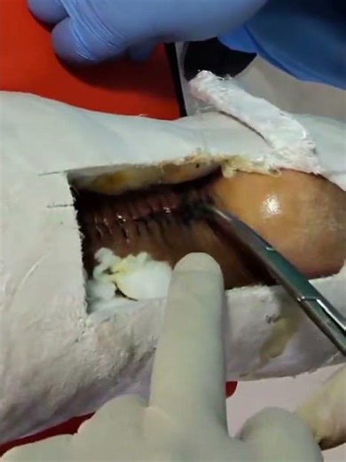 LESION TENDON DE AQUILES SUTURA Y REVISION DE HERIDA.ACHILLES TENDON INJURY SUTURE AND WOUND REVIEW.