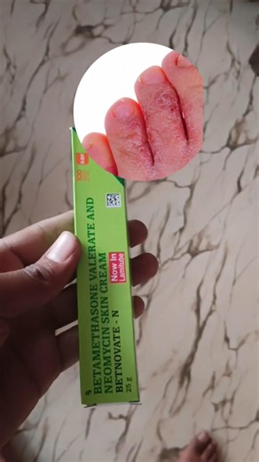 Betnovate N cream use in benefits #skin #Neomycin