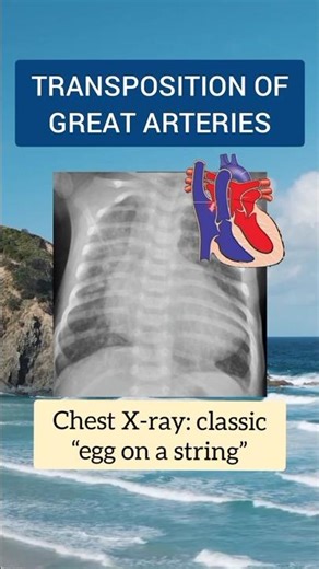 TGA Newborn | Egg on String X-Ray
