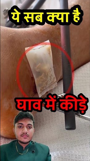 maggot therapy #maggottherapy #maggots #woundtherapy #healing