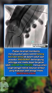 Pijatan Bantu Kateter?