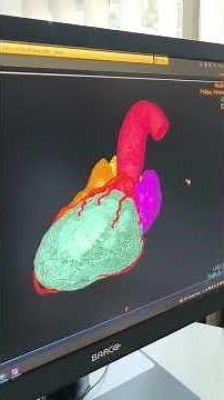 Neinvazivna MSCT koronarografija #CT #ctscan #radiology #heartstroke #heartattack #medikol