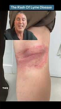 The Rash Of Lyme Disease