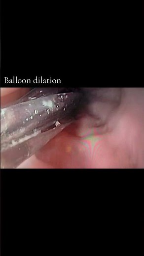 Balloon Dilation for DysphagiaEsophageal Stricture? Here’s How We Fixed It #Dysphagia #GIHealth