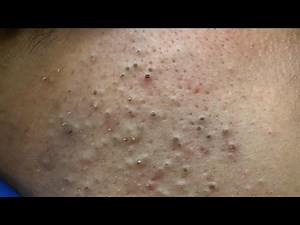 Deep Pore Cleansing | Blackhead Removal From Face | Korean Skincare Routine