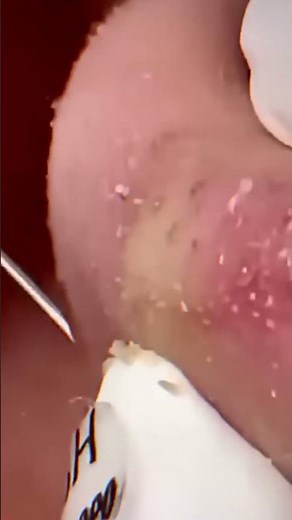 Skincare ｜ Blackheads Removal #tweezer #skincare #blackheads 19