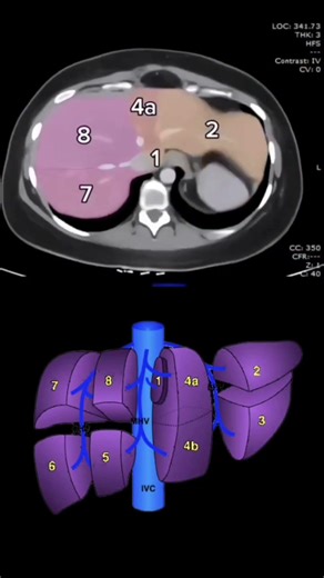 Liver segments on CT scan #CT #radiology