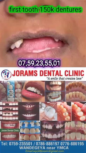 Best Teeth Replacement Options: Dentures Explained