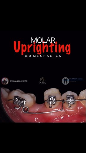 СООБЩЕСТВО ВРАЧЕЙ-ОРТОДОНТОВ🔝 on Instagram: "Автор @dr.mazentarek 🚨Molar uprighting🚨 ———————————— 🔹Placement of uprighting spring to upright mandibular second molars 🔹An uprighting spring is a 1-couple system. 🔷An intrusive component of force exists in the anterior segment along with an extrusive force on the molar with a counterclockwise moment (moment of couple) to UPRIGHT THE TIPPED MOLAR. . . #orthoyourway @duradentalcentereg"