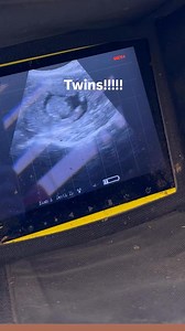 Surprise! Double the blessing. It’s twins! ❤️ #twins #ultrasound #doubleblessing #surprise | Jack H.