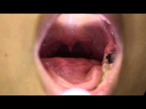 Submucous Cleft: La fissura palatina submucosa