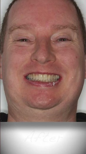 Before & After Teeth Crowding Braces Treatment