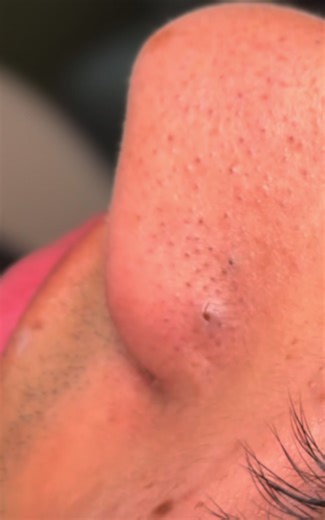 Extra Large Blackhead Extraction ASMR