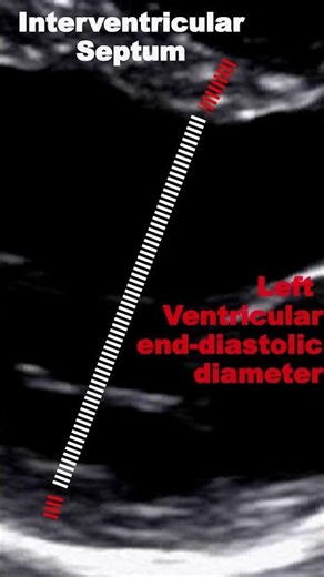 Measuring VI with 2D echocardiography - PLAX view