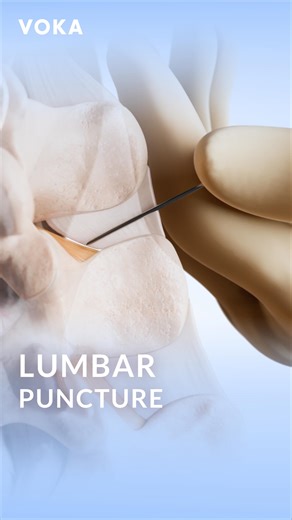 VOKA 3D Anatomy & Pathology on Instagram: "What happens during a lumbar puncture? A lumbar puncture, also known as a spinal tap, is a diagnostic procedure used to collect cerebrospinal fluid (CSF), measure intracranial pressure, and administer medications directly into the spinal fluid. This procedure is essential for diagnosing conditions such as meningitis, multiple sclerosis, and intracranial pressure abnormalities. 📌 Learn more about the human body with VOKA 3D Anatomy & Pathology! #lumbarp