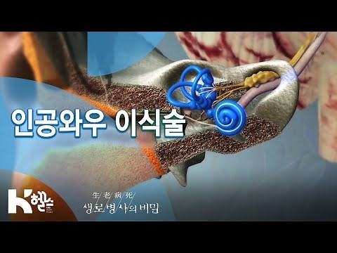 [생로병사의 비밀] 712회 핫클립👀 - 인공와우👂🏻 이식술