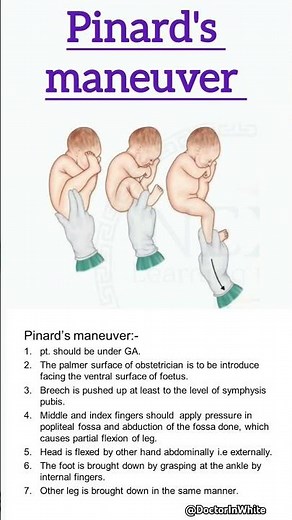 Pinard's maneuver | #viralshort #pinardsmaneuver