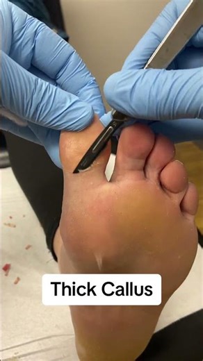 Satisfying Thick Big Toe Callus Removal with Scalpel ASMR #FootCare #Podiatrist