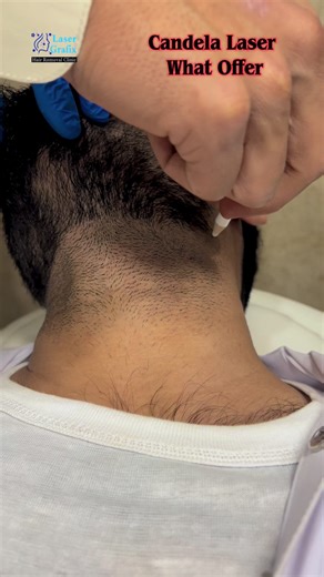Candela Laser Hair Removal by Mansoor