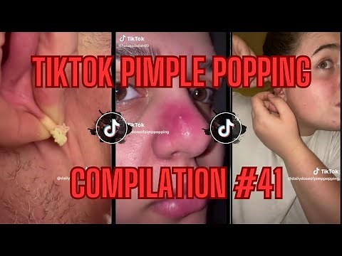 How Did A Pimple Get In There?!? | TikTok Pimple Popping Compilation #41