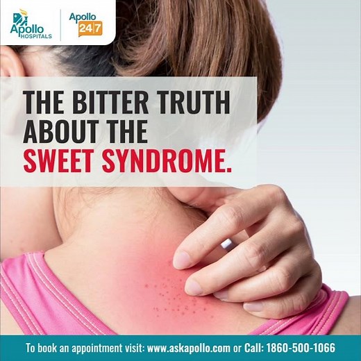 What causes Sweet Syndrome? | Can Sweet Syndrome be cured? | Apollo Hospitals