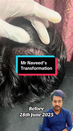 Clinical Hair Regrowth Success: Mr. Naveed's Journey