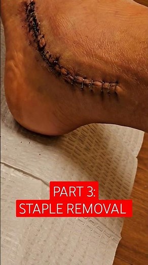 PART 3 STAPLE REMOVAL FROM SURGICAL INCISION #surgeryrecovery #surgery#nature #asmr