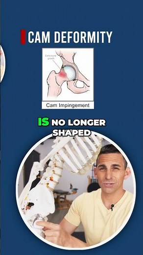 What is a CAM Deformity?