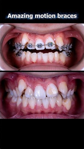 Braces transformation. From crooked teeth to perfect smile #braces #orthondotist #orthodontics