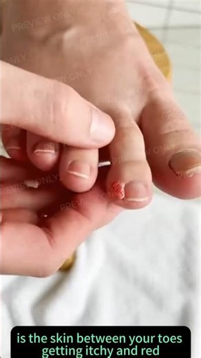 Do You Really Know This Comment Foot Infection? #health #skincare #cosmeticdermatology