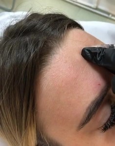 ✔️Toxina botulinica (Botoxul) ajuta pentru relaxarea musculara temporara astfel incat ridurile nu mai sunt vizibile in aceasta perioada. ✔️Se instaleaza treptat in 7-14 zile, iar efectul este pentru cateva luni. ✔️De obicei, pacientii apeleaza pentru acest tratament estetic de 2 ori pe an. ✔️Este o procedura simpla, se poate realiza si in pauza de masa intrucat dureaza doar 5 minute. ✔️Nu necesita timp de recuperare | Clinica Beauty Art Aesthetics