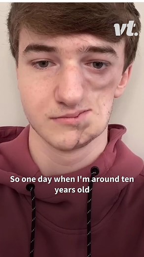 This guy has revealed what it's like to live with Parry-Romberg Syndrome. | VT