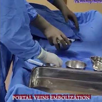 Portal Vein Embolization