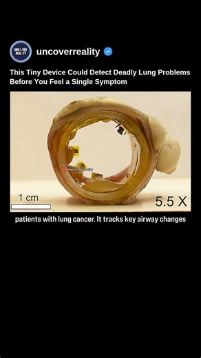 New Ring Technology Could Detect Deadly Lung Problems Before You Feel a Single Symptom #tech #shorts