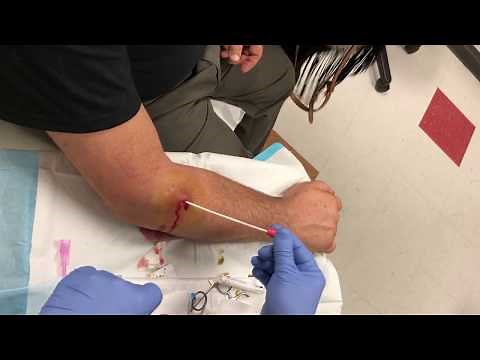 Right arm abscess - mild. Needs Packing