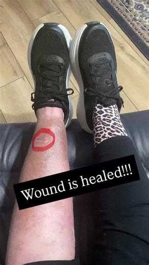 Teresa Lewis Freund on Instagram: "🎉🎉🎉 LEG WOUND UPDATE!!!!! 🎉🎉🎉 Look how GREAT my wound looks…..and my leg too!!!! THE color is so much better and so is the swelling!! It finally looks like a REAL LEG again!! 😱🤩 This was my LAST WEEKLY visit!!! 👏👏👏 Insert a vey careful happy dance HERE!! 💃 I told them I felt like I should get to ring a bell or something!! 🔔 They have CLACKERS and did those for me!!!!! 🥳 The Freeman Wound Center staff, along with Dr Newman, are amazing and I can’t
