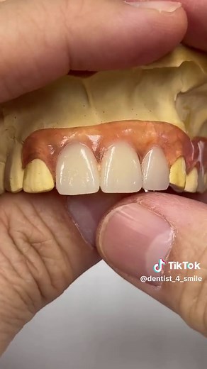 Flexible Partial Denture for a Comfortable Fit
